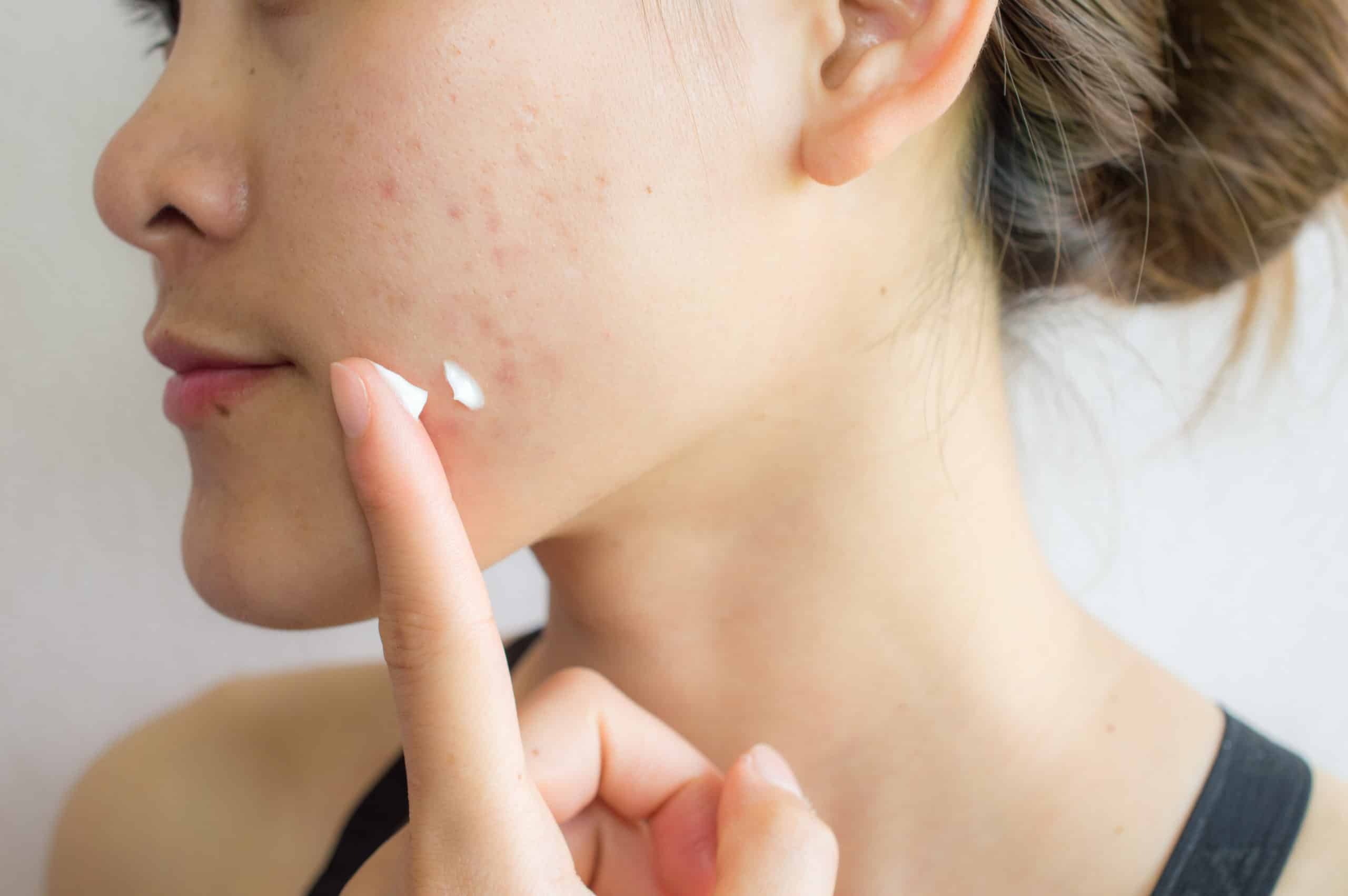 does-acne-get-worse-before-it-gets-better-dwh-medspa-dominion