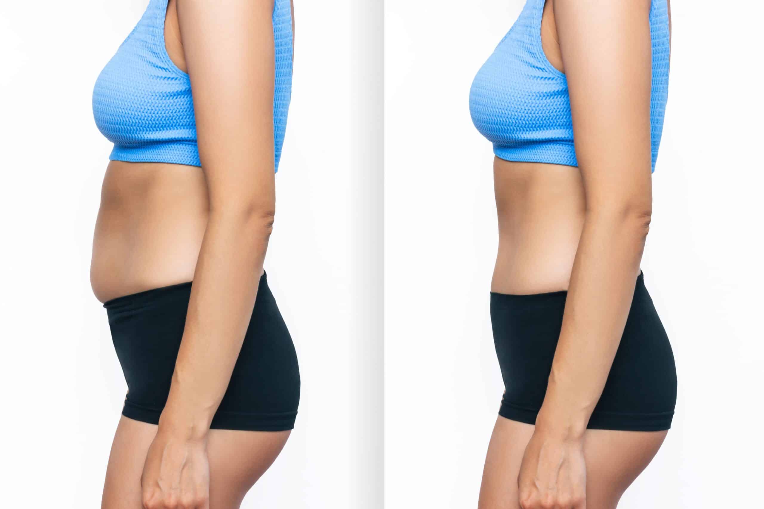 woman after sculpsure