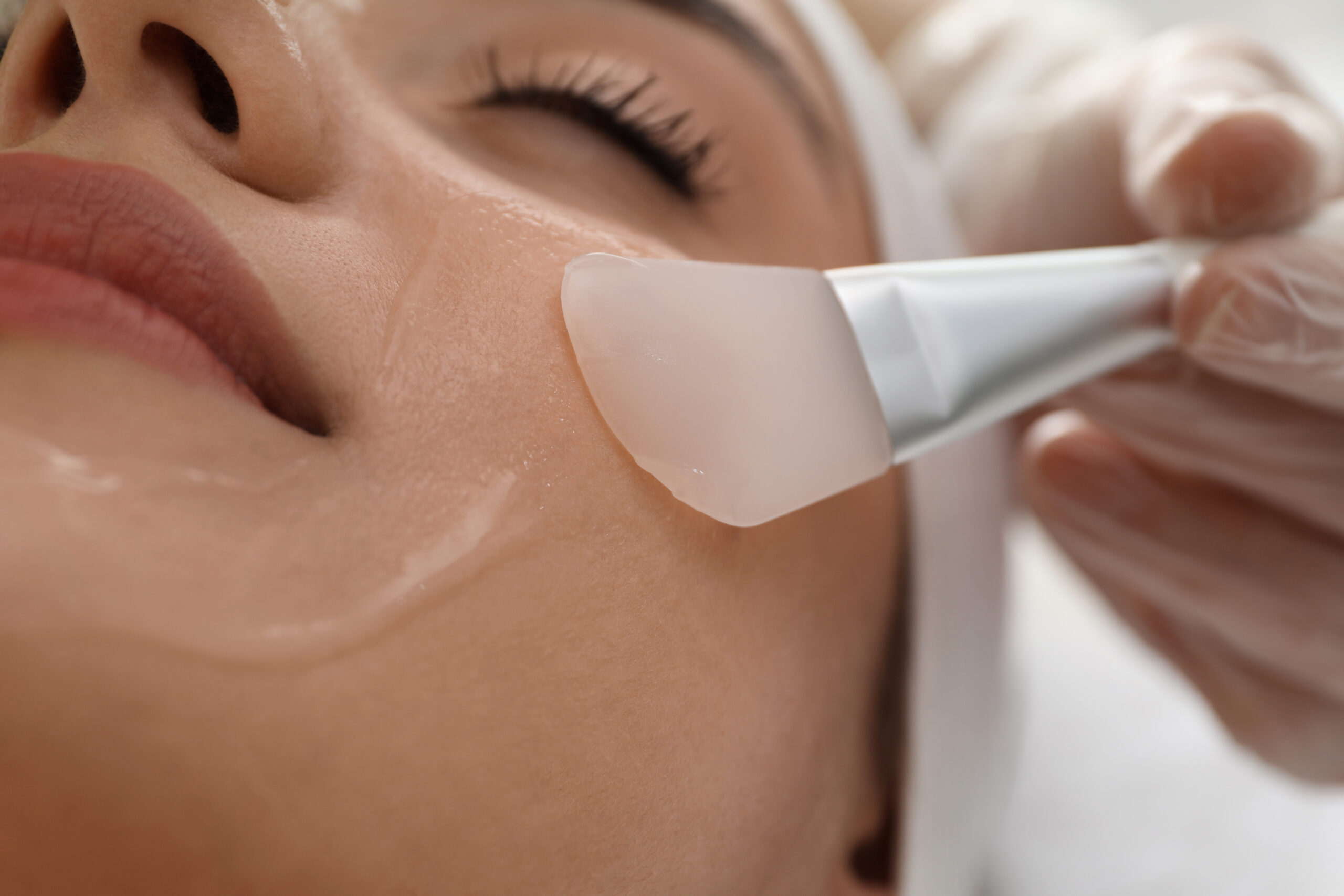 chemical peel healing